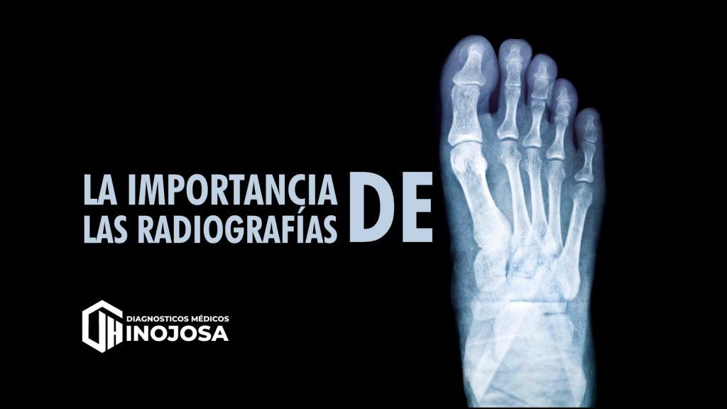 Las radiografías de pie son un método de diagnóstico utilizado para detectar problemas en los huesos y articulaciones de los pies. Estas imágenes claras y precisas permiten identificar fracturas, deformidades y otras afecciones que pueden afectar la movilidad y la calidad de vida.