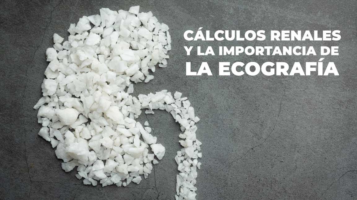 calculos-renales-del-riñon-y-la-importancia-de-la-ecografia