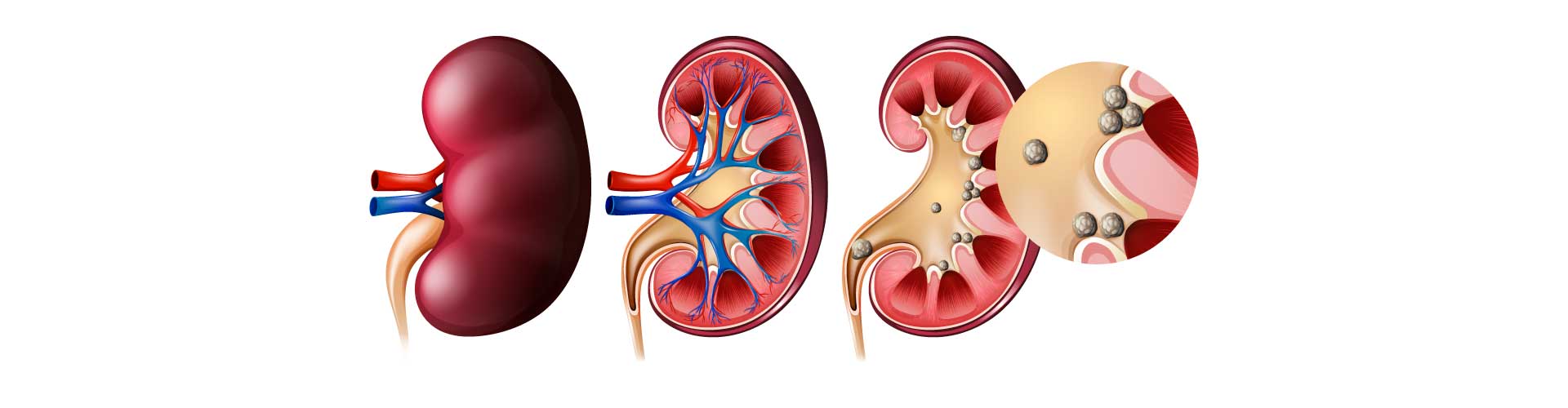 calculos-renales-etapas-del-riñon