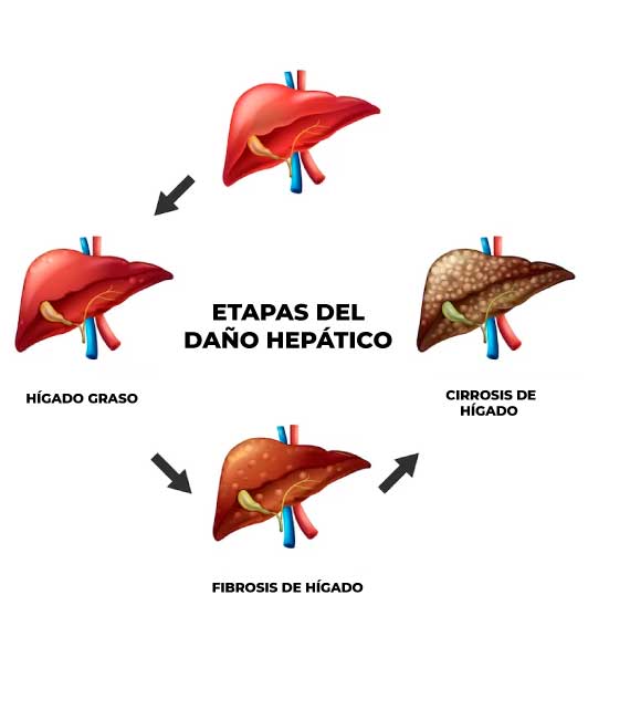 etapas-del-higado-graso